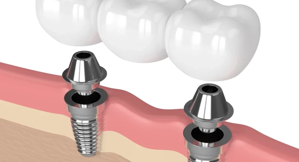 grafika Mosty na Implantach