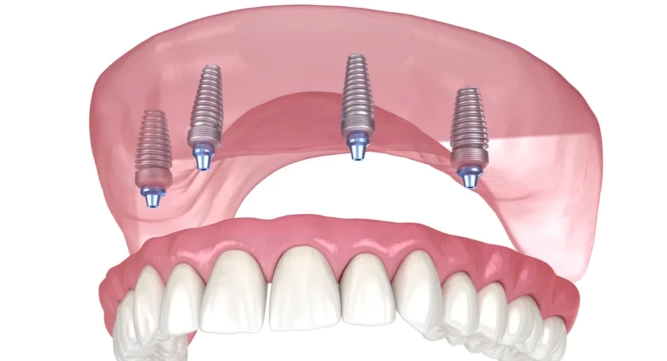 grafika Proteza Overdenture