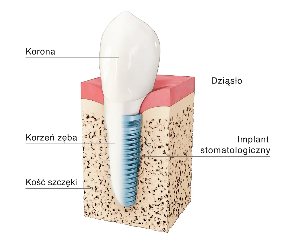 grafika Proces Zakładania Implantów